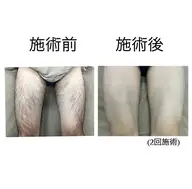 下半身脱毛