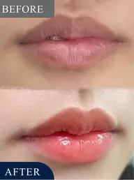 くちびるの色素沈着、色ムラ改善ケア！