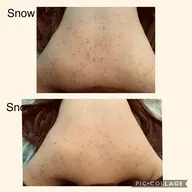 【背中美人】ブライダル必見！！背中集中ハーブピーリング60分　9800円​〜​　剥離なし