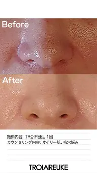 【モニター募集】毛穴集中ケア人気No.1★黒ずみ・開き改善フェイシャル