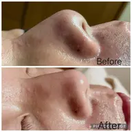 小鼻の黒ずみ&いちご鼻気になる方におすすめ(ニキビ、リフトアップ)