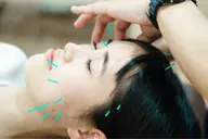 初めての【美容鍼】