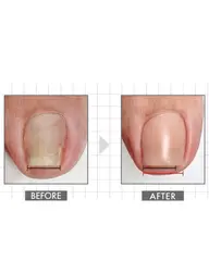 巻き爪ケア【ヘイスイッチ】