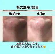 フェシャル★お試しモニター価額9350円 →5000円〇毛穴ケア人気NO.1超音波毛穴洗浄+ビタミン導入★条件有り