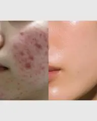 【初回限定】大人ニキビケア|美容鍼×フェイシャルケア