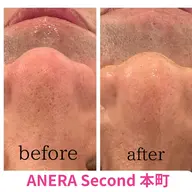 【メンズ限定】男前は作れる★小顔矯正&ハイドロスプラッシュ毛穴洗浄8,900円