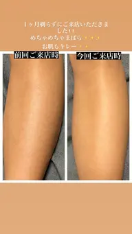 woman 全身脱毛(顔・vio除く)