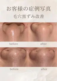 【開き毛穴・黒ずみ】毛穴洗浄/肌質改善(カウンセリング込)コース☆