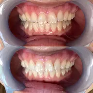 セルフホワイトニング🦷2回照射