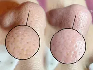 《ピーリング付き》毛穴エクストラクション（鼻のみ）➕1,000円で１パーツ追加🆗