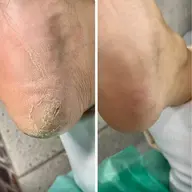 【踵のひび割れ】痛みがある方❗️痛みがなくても硬さや見た目が気になる方⚠️専用の器具で優しく、効果的に施術いたします