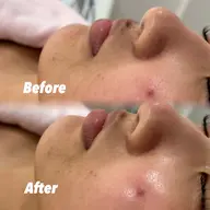 【動画撮影OKな方🎞⟡.·】⚠️土曜日19:00​〜​限定⚠️ 顔シェービング+パック