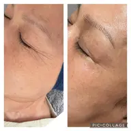 たるみ・しわのお悩みの方に★REVI陶肌トリートメント