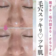 〈毛穴の黒ずみに🌟〉ハイドラ毛穴洗浄