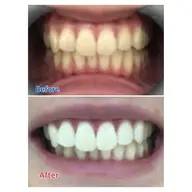 ☆minimo限定☆学割!ホワイトニング体験ロングコース🦷!