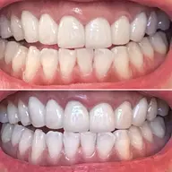 【ダブル照射】オーラルケア🦷✨15分＋15分の2回照射で30分❣メンズも大歓迎♪