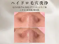 毛穴洗浄◇ハイドロフェイシャル【白玉艶肌パック仕上げ/美白】