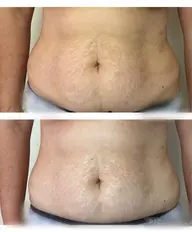 【脂肪撃退！】全身60分どこでも当て放題！脂肪＆セルライトにアプローチ✨キャビテーション&ラジオ波&EMS（筋肉運動）