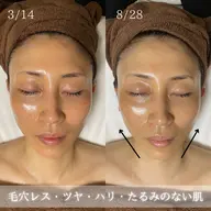 【艶肌美肌！】ミコステラでお肌のトラブル改善