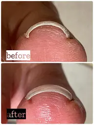 限定→残り2名（10名募集）‼️痛みとさよなら👋🏻足爪のトラブル巻き爪•陥入爪•変形爪•肥厚爪•たこ　詳細へ↓