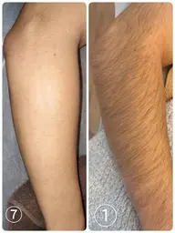 【清潔感爆上げ🔥触れたくなるツルスベ肌へ💖自己処理のいらないお肌✨うで脱毛✨】(ひじ上・ひじ下・指)💎