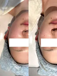 【お試しでも可能】肌育成ハーブピーリング ［半顔］※翌日からメイク可能✨一回で肌質が変わる🌿