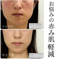 NEW光フェイシャル(ラジオ波)でお顔の引き締め、たるみ、シミ、シワ、ニキビ跡コース