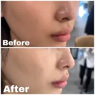 毛穴ケアコース