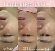 韓国発【最新肌育】ツヤ、ハリ実感ラミネーションピール/ラミピール