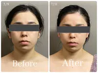 通常価格【マリオネット】筋膜リリース×美顔器＝小顔・造顔★60min【¥13200→¥6600】