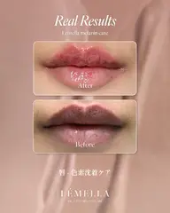 韓国No.1シェア【メラニン除去ケア】 リップ＊アフタークリーム1個(¥17,000)付き