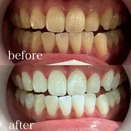 🦷🔰本日限定まずはお試し🔰🦷ナチュラルホワイトニング✨【通常¥9900→初回¥1980❤️‍🔥】今だけ価格！