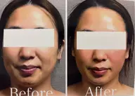 【ほうれい線】ゴルゴライン・マリオネット改善✴︎80min【¥18,700→¥8,800】