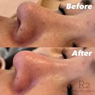 【フェイシャル】毛穴ハイドロピーリング(顔全体コース)¥4500