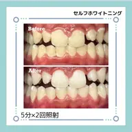 【学割すぐ予約解放日限定】セルフホワイトニング