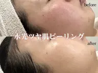 【毛穴レスピーリング】ラミネーションピール×カーボキシー