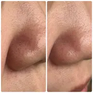 毛穴洗浄　角質ピーリングコース🫧