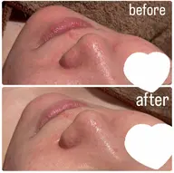 【学生＆20代前半限定🎀】肌荒れケアフェイシャル✨