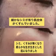 【シミ、ほくろ取り】パワーライト5か所