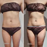 【話題の脂肪痩身マシン】✨LUMIX LIPOCOOL✨4カップ