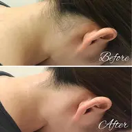 《何度でもOK》うなじ脱毛