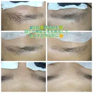 全顔脱毛3,300円＋眉毛脱毛（2,200円）