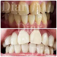 🦷セルフホワイトニング🦷(2回照射)