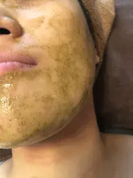 モニター様《剥離なし》ハーブピーリング🌿