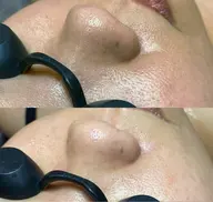 美肌【ツルツルむき卵肌へ]小鼻黒ずみ吸引x毛穴洗浄x小顔コルギ60分