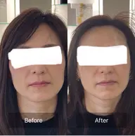 【ダーマショット】シワやたるみ、ニキビ跡、ほうれい線が気になる方に!!マイクロニードルでお肌の奥に直接アプローチ✨