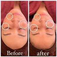 陶肌トリートメント　　ハーブピーリング