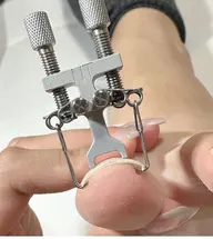 【韓国式🇰🇷】巻き爪ケア／その日から痛くなくなる！