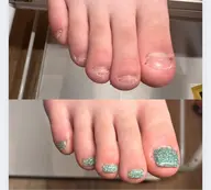 【新規様限定】フット🦶深爪矯正/オシャレを楽しみながら深爪矯正​〜​ワンカラー仕上げでお爪の長さ出し