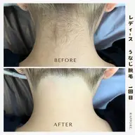 顔➕うなじ脱毛セット🍄（シェービング付き）